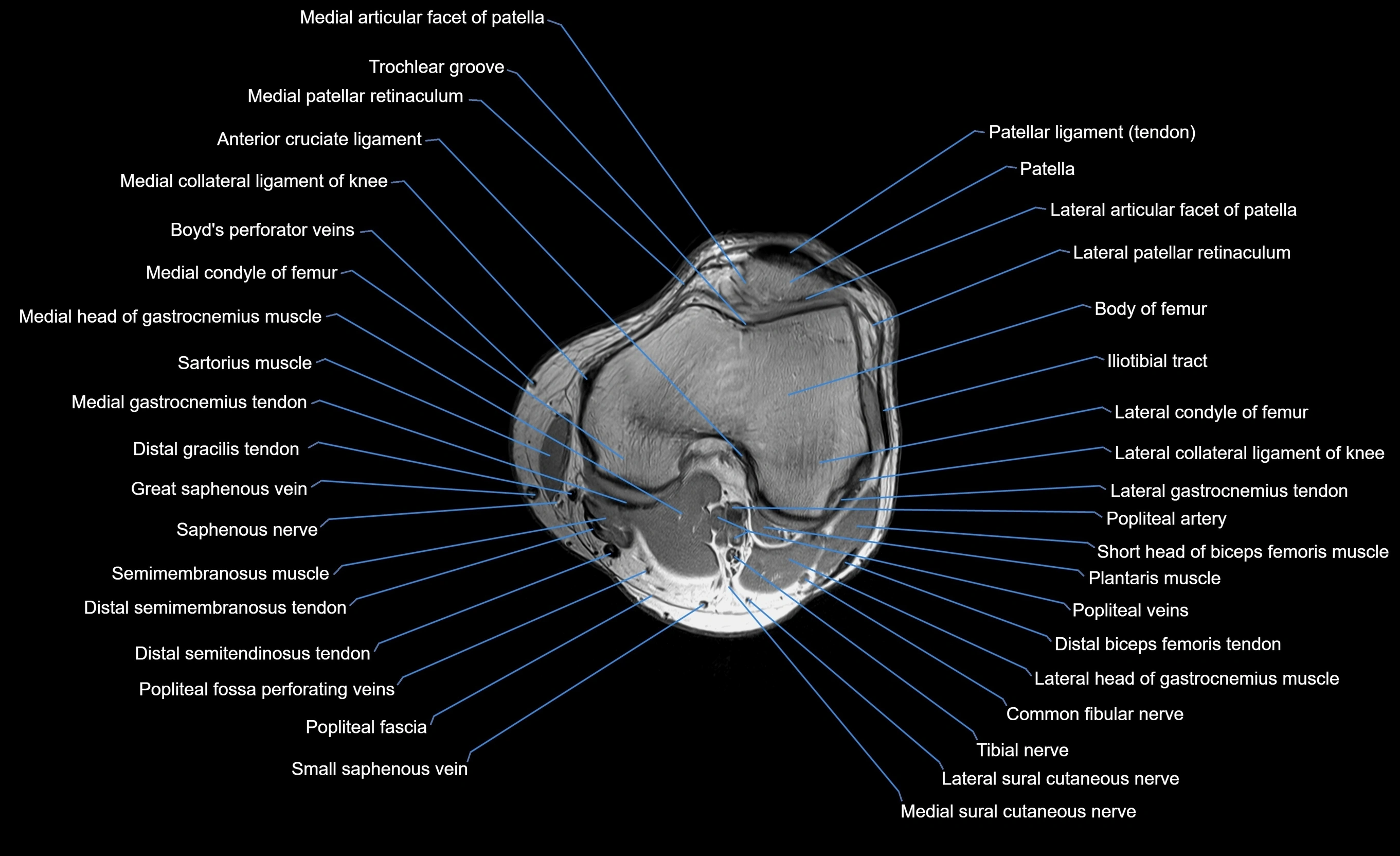 MRI lower leg axial cross sectional anatomy 3T  radiology  image-img-00001-00010.webp